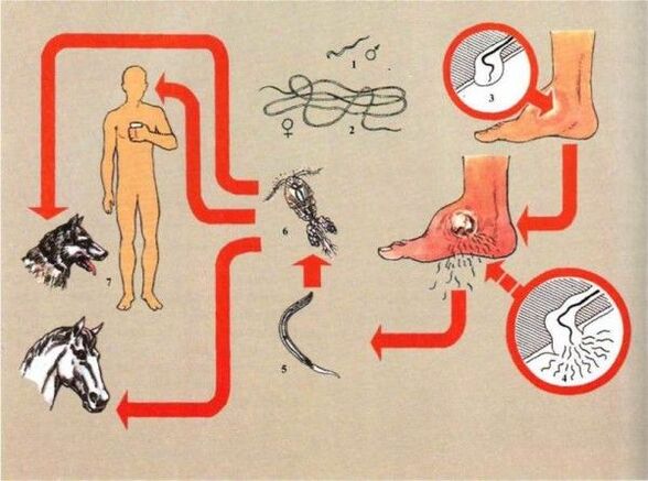 Desarrollo de dracunculosis.